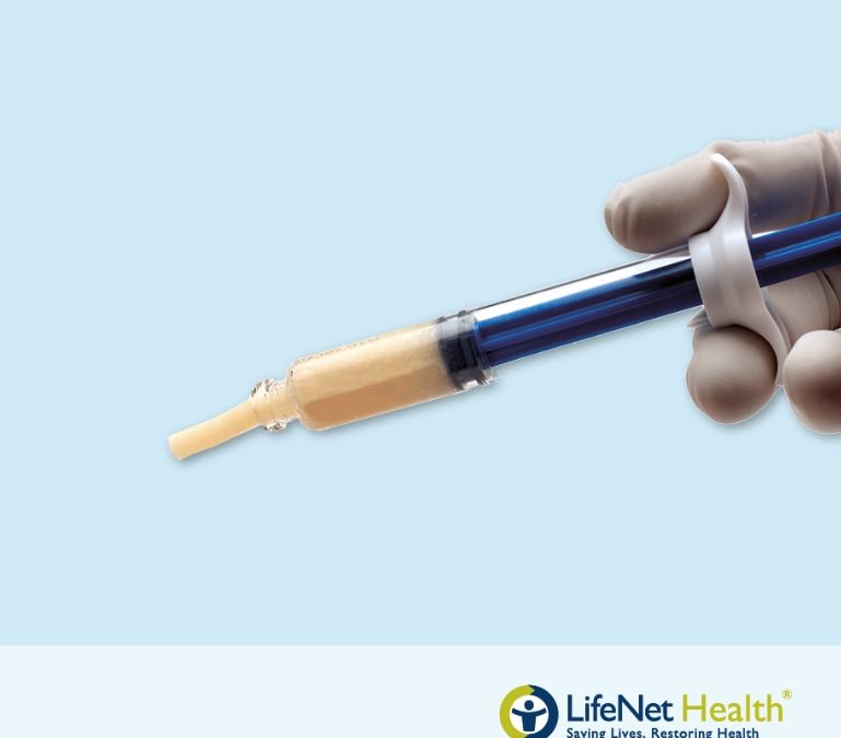 Matriz Ósea Cortical Desmineralizada en pasta con chips de hueso esponjoso