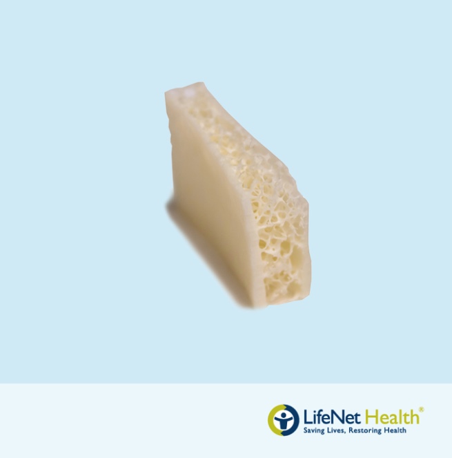 Tira Hueso Ilíaco Hidratada PRESERVON®